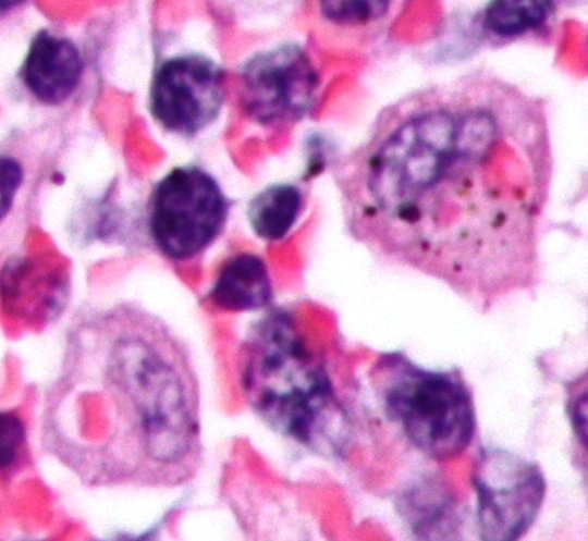 Hämophagozytisches Syndrom